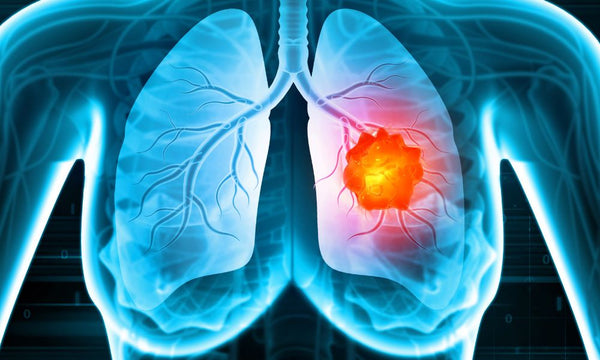Why Exposure to Radon Can Cause Lung Cancer
